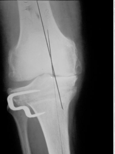 Howmedica Coventry HTO Staple (Implant 156)